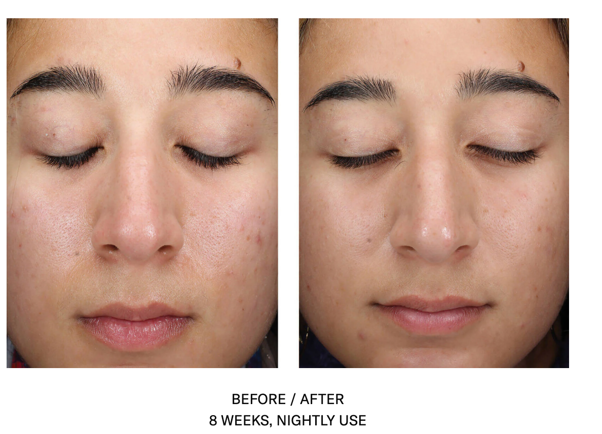 AlphaRet Clearing Serum