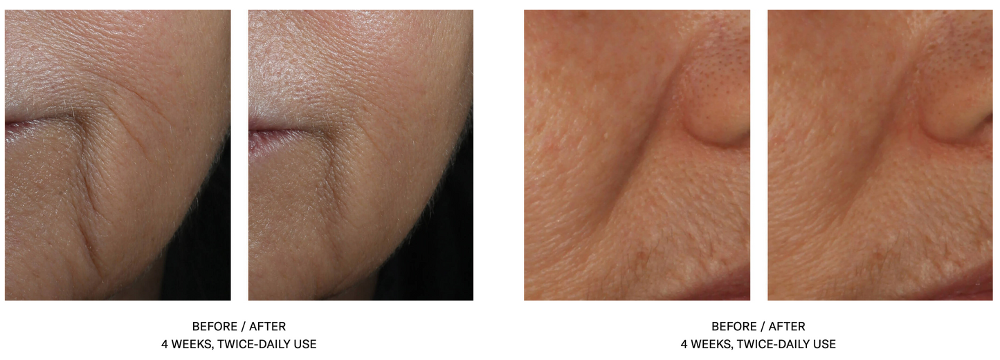 InterFuse Intensive Treatment LINES