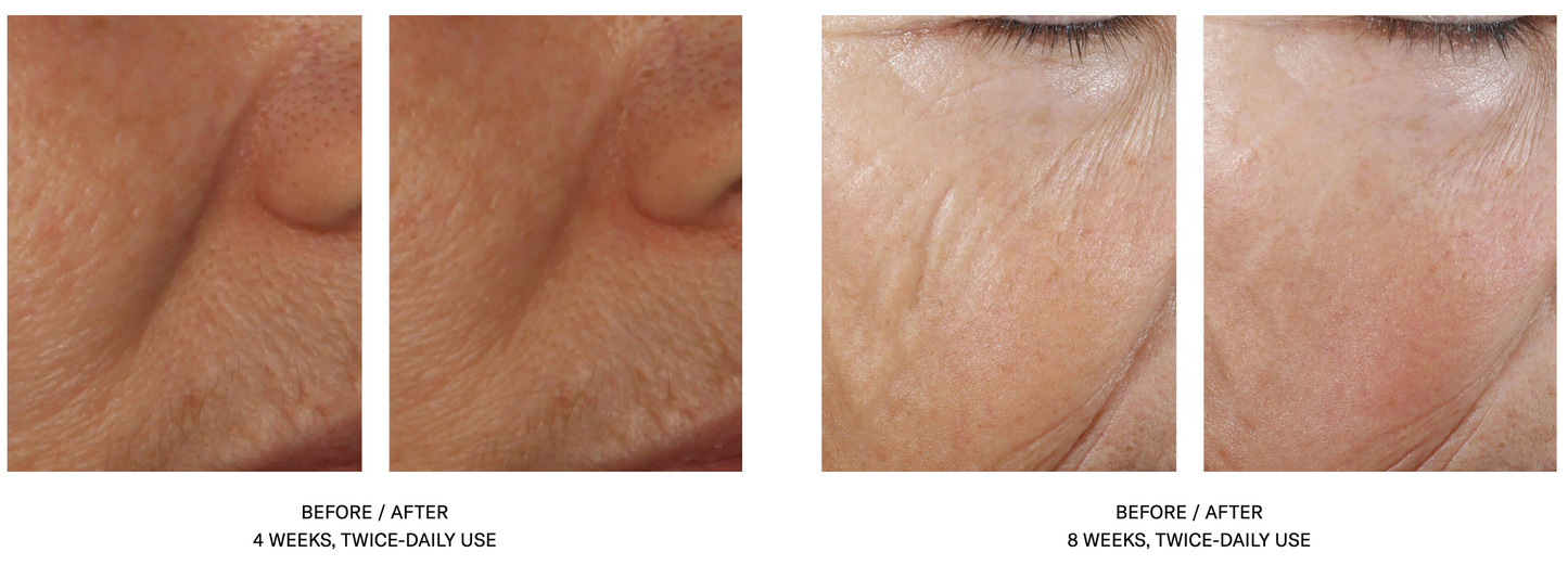 InterFuse Intensive Treatment LINES